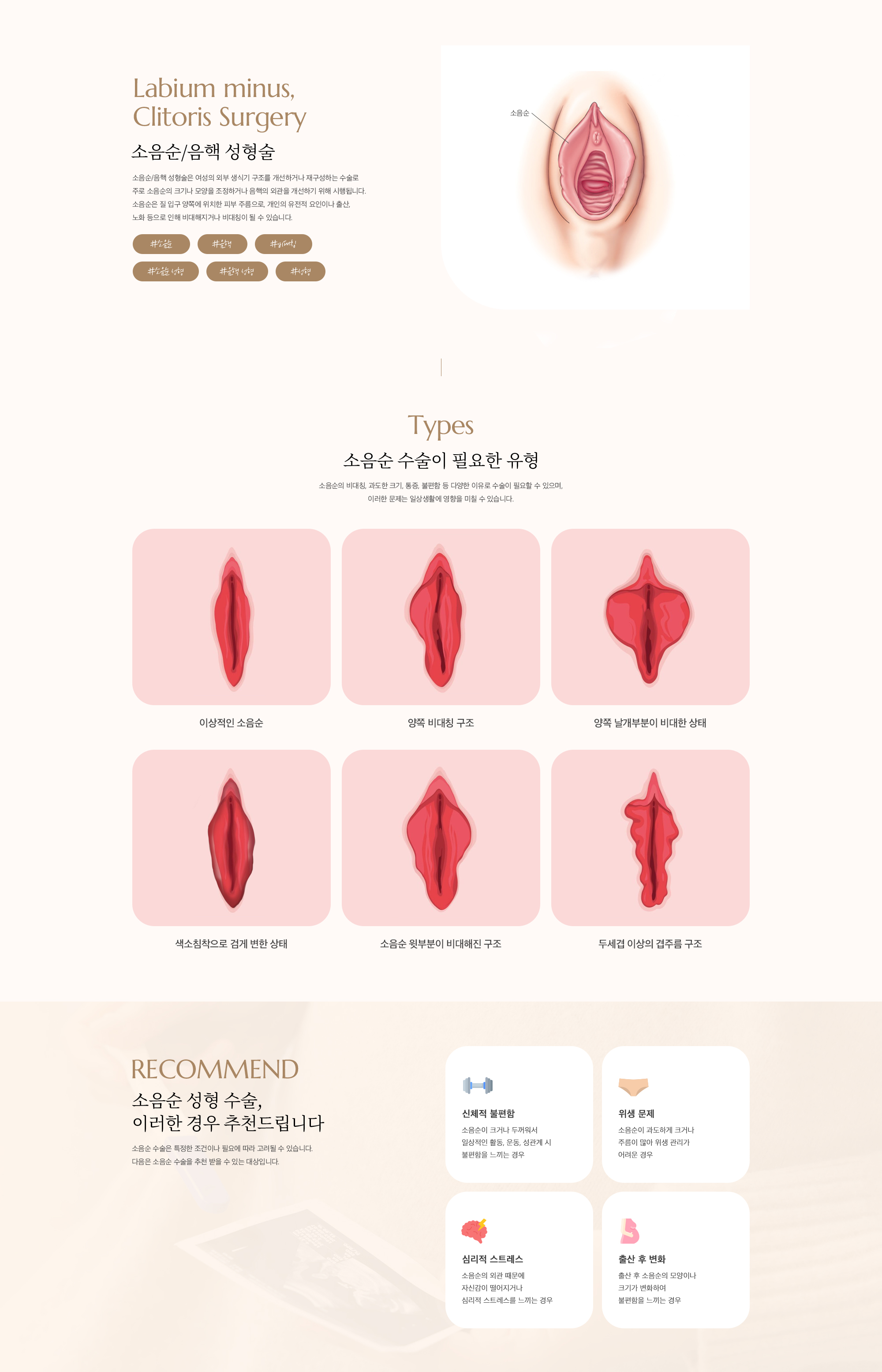 소음순/음핵수술