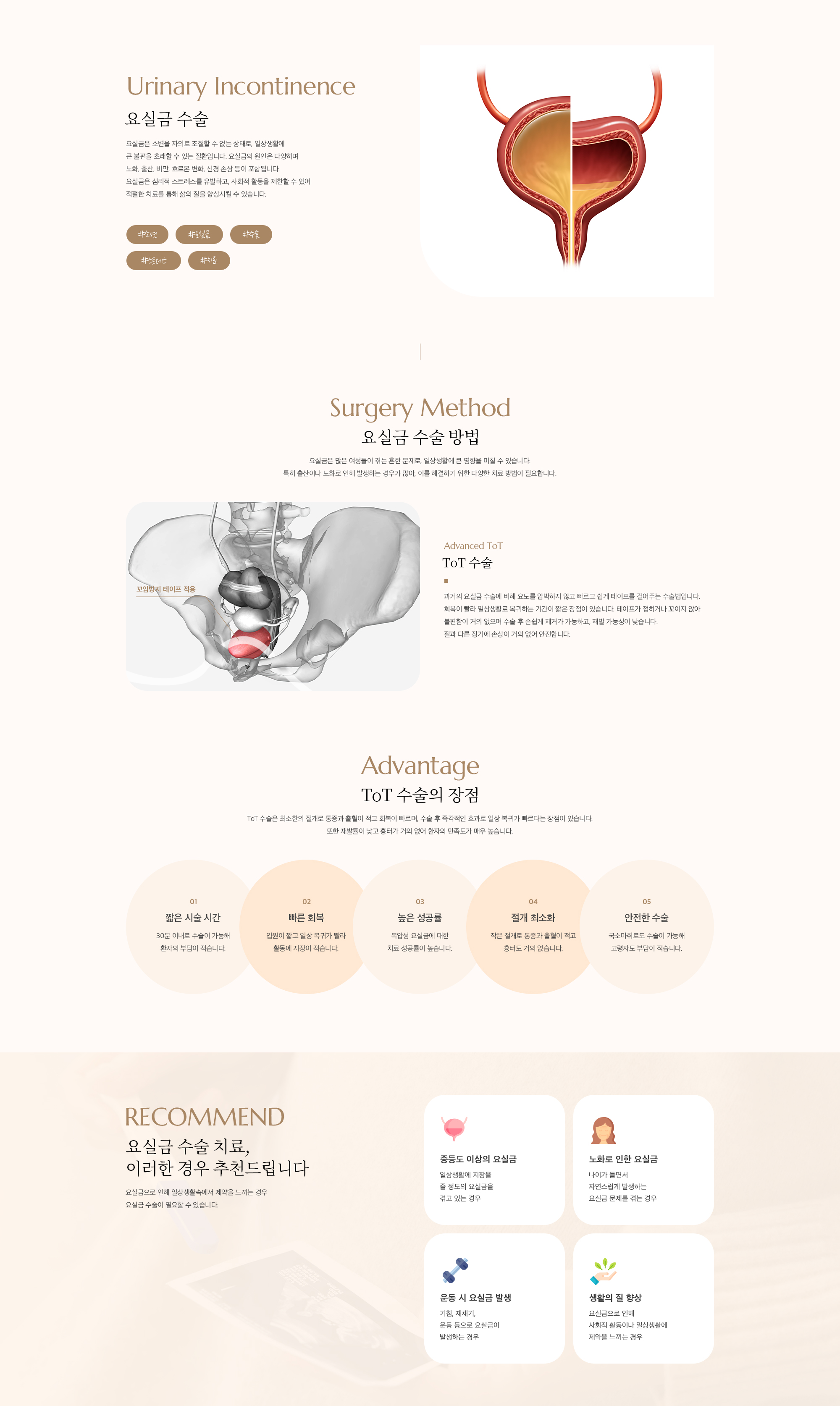 요실금 수술(Advanced TOT)
